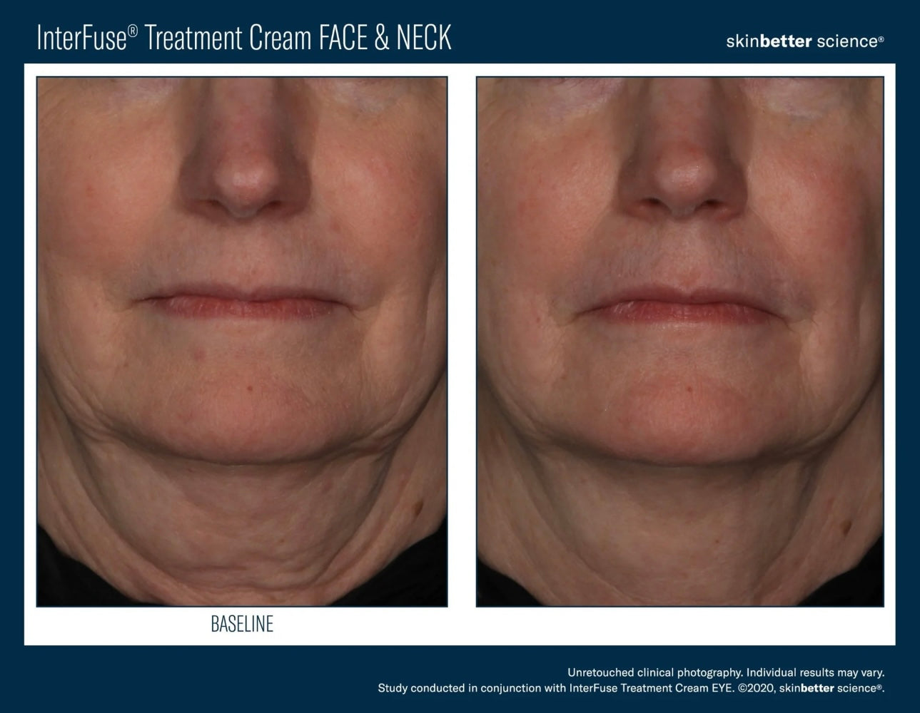 SkinBetter Interfuse Treatment Face & Neck Cream